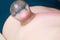 Alternative medicine. Fire cupping massage detail on woman\'s back