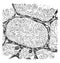 Alveolar sarcoma, vintage engraving