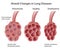 Alveoli in lung diseases