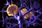 Alzheimer's and dementia disease: amyloid plaques forming between neurons. 3D illustration showing amyloid plaques