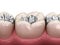 Amalgam restoration. Medically accurate 3D animation of dental concept