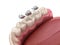 Amalgam restoration. Medically accurate 3D animation of dental concept