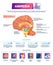 Amnesia vector illustration. Labeled brain memory loss disease types scheme