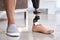 Amputee man with above knee leg prosthesis standing on feet, close up.