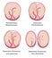 Anatomy of abdomen with twins. Twin types infographic elements in flat design