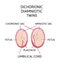 Anatomy of abdomen with twins. Twin types infographic elements in flat design. Monozygotic or Dizygotic Placentation of twins
