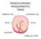 Anatomy of abdomen with twins. Twin types infographic elements in flat design. Monozygotic or Dizygotic Placentation of twins