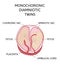 Anatomy of abdomen with twins. Twin types infographic elements in flat design. Monozygotic or Dizygotic Placentation of twins