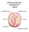 Anatomy of abdomen with twins. Twin types infographic elements in flat design. Monozygotic or Dizygotic Placentation of twins