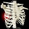 Anatomy and human body. Costochondral separation, separated rib. Broken, fractured ribs. Bones in the rib cage breaks or cracks