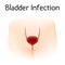 Anatomy picture of bladder infection, pain. Realistic medical illustration. Woman body silhoutte