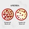 Anemia amount of red blood Iron deficiency anemia difference of Anemia amount of red blood cell and normal symptoms vector illustr