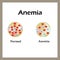 Anemia. The reduced amount of red blood cells. Infographics. Vector illustration