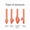 Aneurysm. Types aneurysm. Infographics. Vector illustration