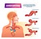 Aneurysm vector illustration. Labeled medical outward bulging vessel scheme