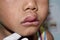 Angioedema at lips of Asian male child. Edematous child. Caused by drug, seafood or chemical allergy and insect bite. Lateral view