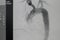 Angiogram of right common iliac artery after aortic stent graft deployed at infra renal abdominal aortic aneurysm during