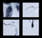 Angiography of brachial artery with Balloon dilatation