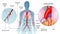 Angiography operation illustration