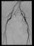 Angiography of the pelvis region