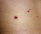 Angioma. Red birthmark on the skin surface