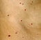 Angioma on the skin. Red moles on the body. Many birthmarks.