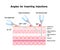 Angles for Inserting Injections vector illustration