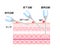 Angles for Inserting Injections vector illustration