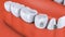 Animation dental brackets