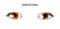 Anisocoria. pupils of different sizes