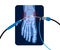 Ankle arthroscopy poster