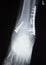 Ankle foot orthopedics implant xray