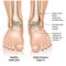 Ankle joint fracture Type c medical vector illustration on white background