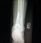 Ankle left tibia distal fracture treatment xray