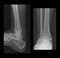 Ankle radiographs