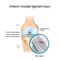 Anterior cruciate ligament injury