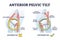 Anterior pelvic tilt model compared with posterior in labeled outline diagram