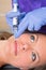 Anti aging facial mesotherapy syringe on woman face