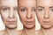 Anti-aging procedures on caucasian woman face