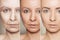 Anti-aging procedures on caucasian woman face