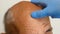 Anti-aging treatments for balding men. Close-up A trichologist in gloves examines a patient with alopecia. Hair growth clinic. The