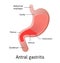 Antral Location of Gastritis, an inflammation of the lining of the stomach. Three types Antral, of the body and