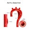 Aortic dissection. longitudinal and cross-section of blood vessel.