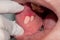 Aphthous ulcer or stress ulcer in mouth of Asian patient