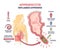 Appendicitis, inflamed appendix, abdominal problem diagnosis outline diagram