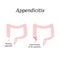 Appendicitis. Inflammation of the appendix. Colon