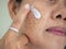 Applying cream treatment skin