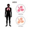 ARDS anatomical poster