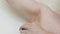 Armpit rash. Cropped photo of irritation, inflammation on sensitive underarm skin after using toxic deodorant or