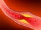 Arteries with clogged fat that causes blood clots